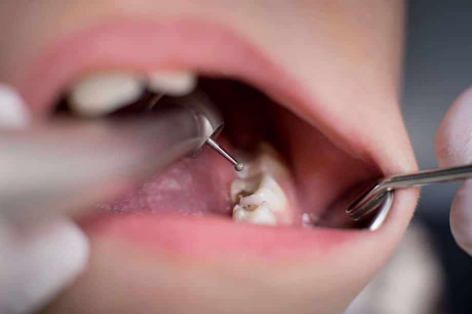 Should Baby Teeth Cavities Be Filled?