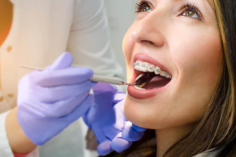 Top 10 Braces Questions and Answers